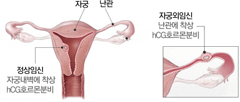 자궁외 임신의 원인과 증상